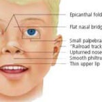Figure 1. Characteristic facial features in a child with fetal alcohol syndrome. These includes a smooth philtrum, thin upper lip, and small palpebral fissures. Other associated features may include an upturned nose, underdeveloped ears, flat nasal bridge and midface, epicanthal folds and small head circumference (source: Darryl Leja, www.nih.gov).