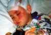 Sturge Weber syndrome explained