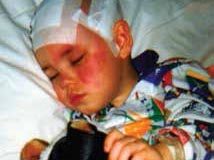 Sturge Weber syndrome explained